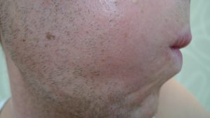 cystic-acne-treatment-brisbane