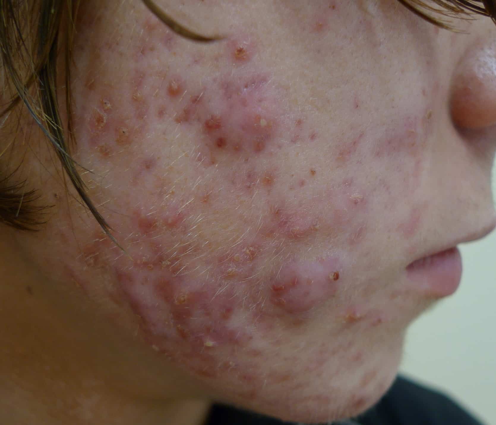 Acne Scar Treatments On Accutane / Oratane Dr Davin Lim
