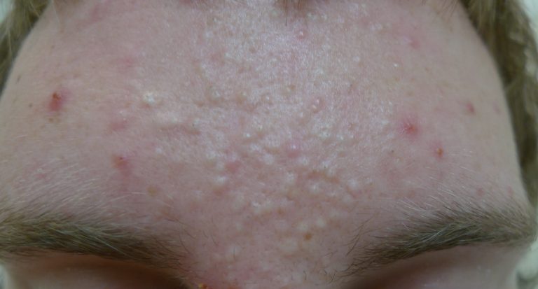 Laser Treatment For Cystic Acne photo