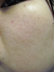 Enlarged Pores & Acne
