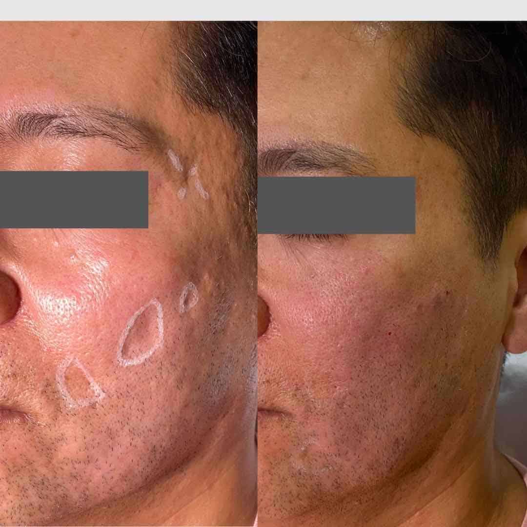 acne scars in male