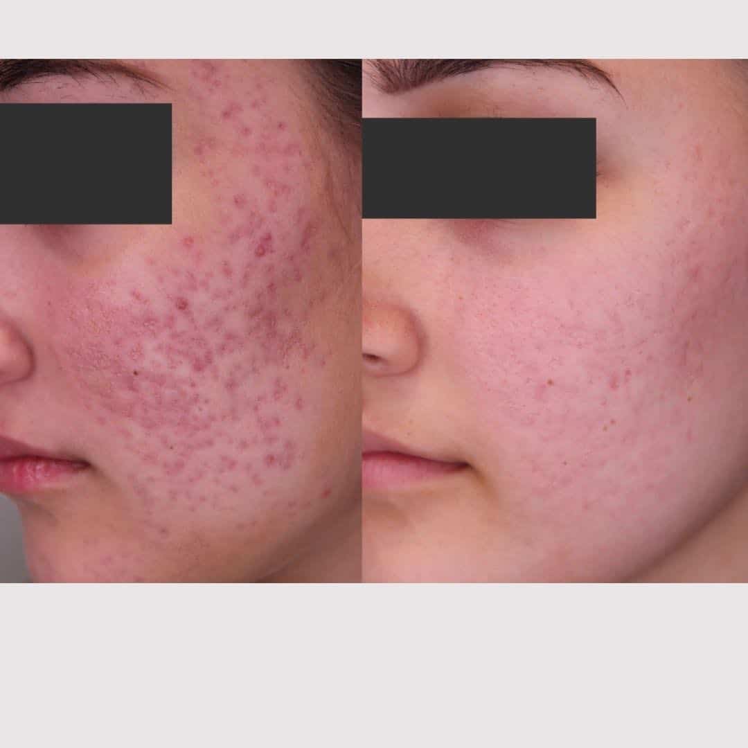 acne-scars-on-cheeks