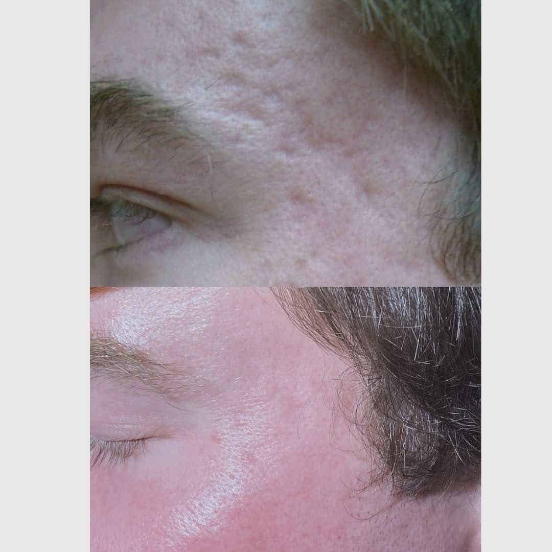 temple-acne scars