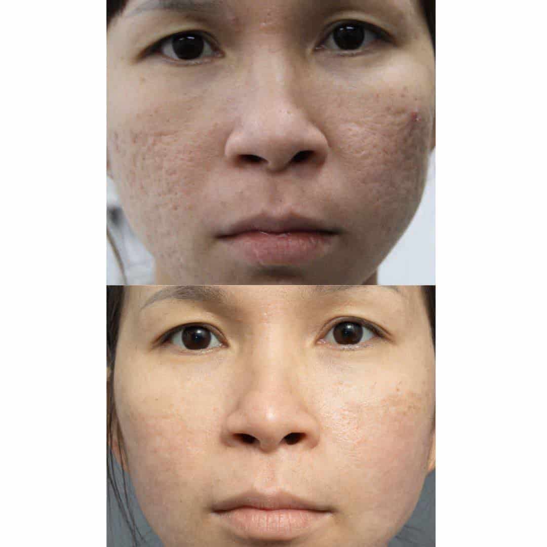 Rolling scars in Asian female