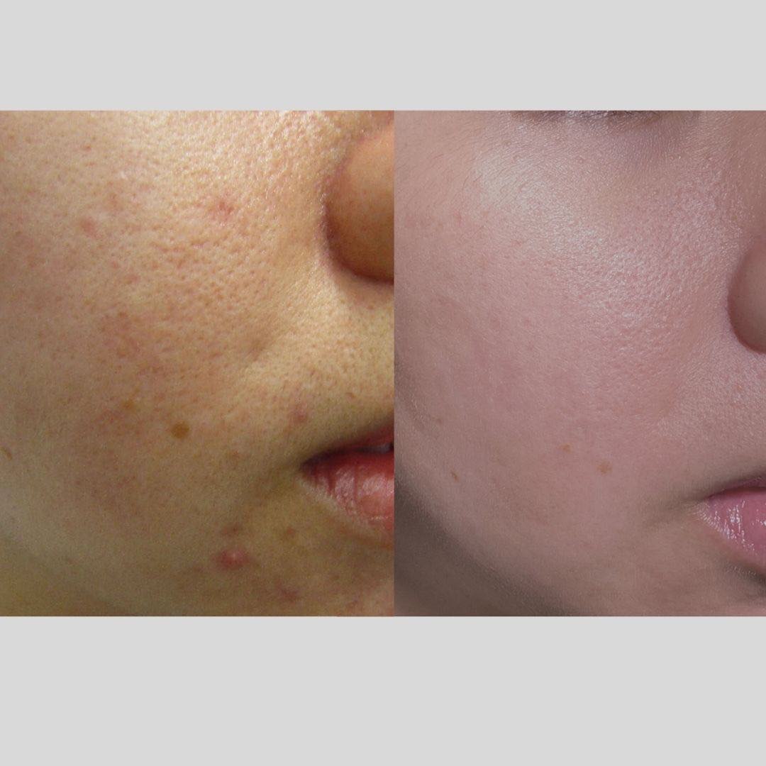 acne-and-enlarged-pores