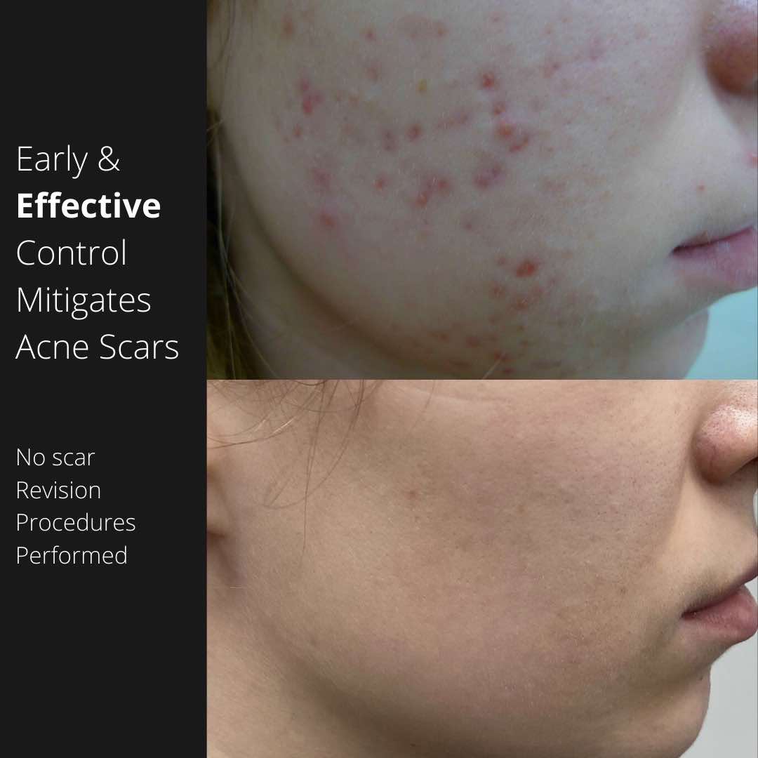 intensif-acne-scars
