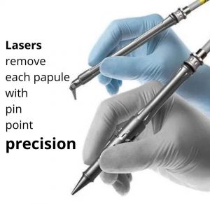 PPP penile laser