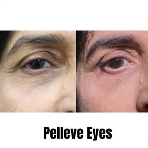 Pelleve Eyes