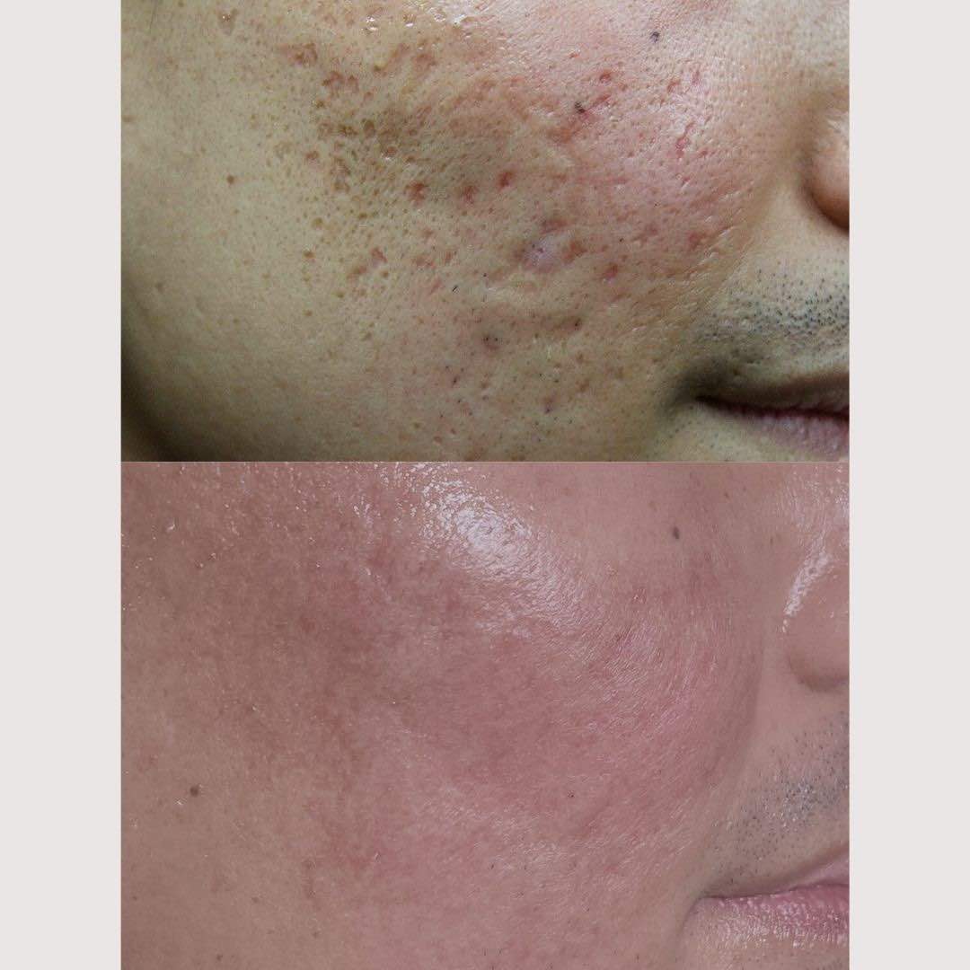 acne scar treatment Davin Lim