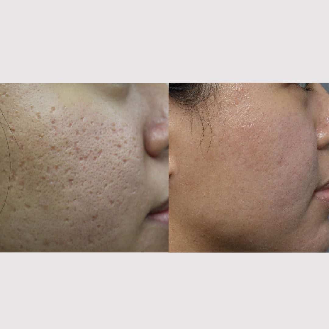 acne-scars-woman