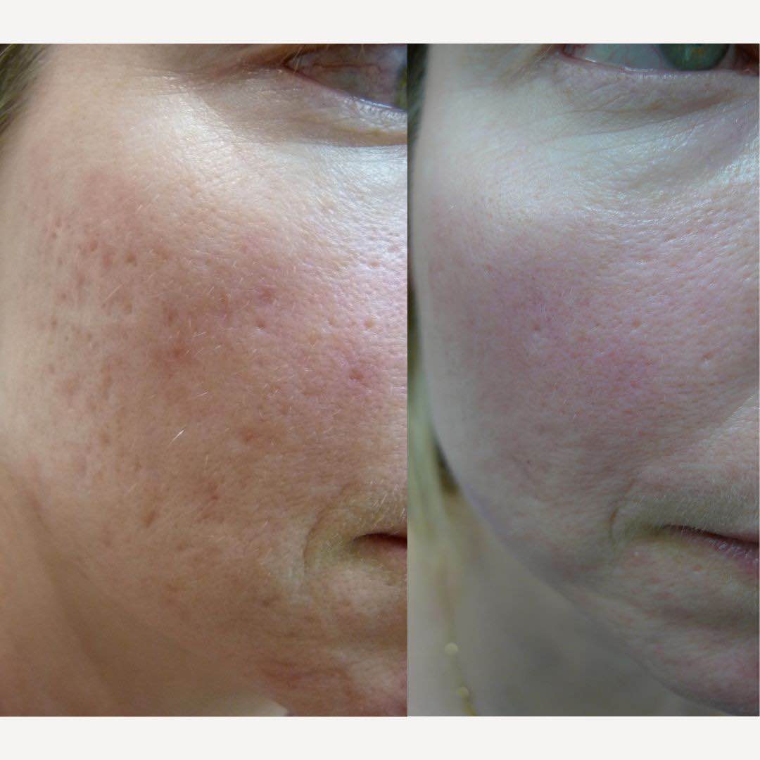 laser resurfacing acne scars