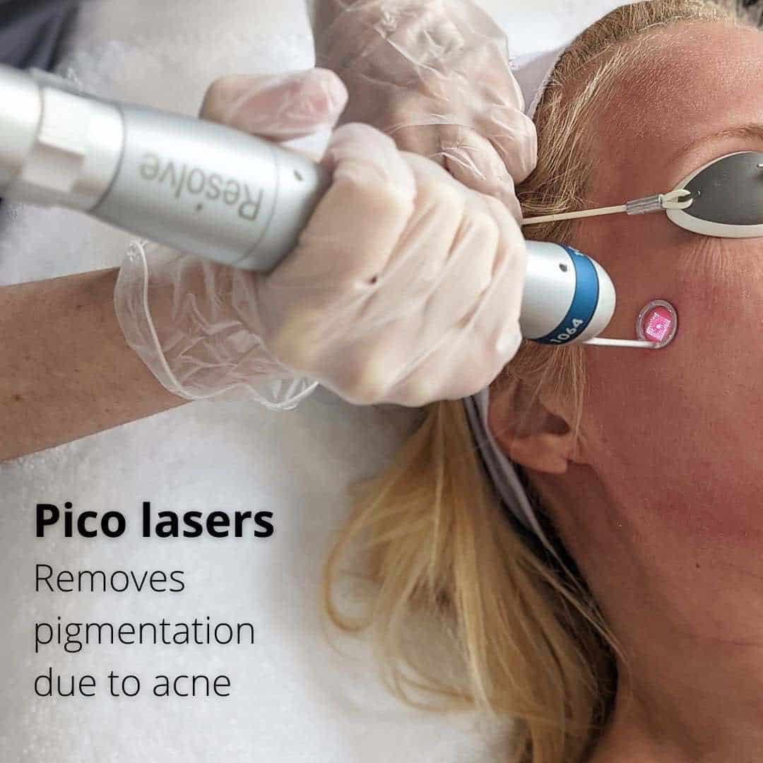 picoway-acne-scars