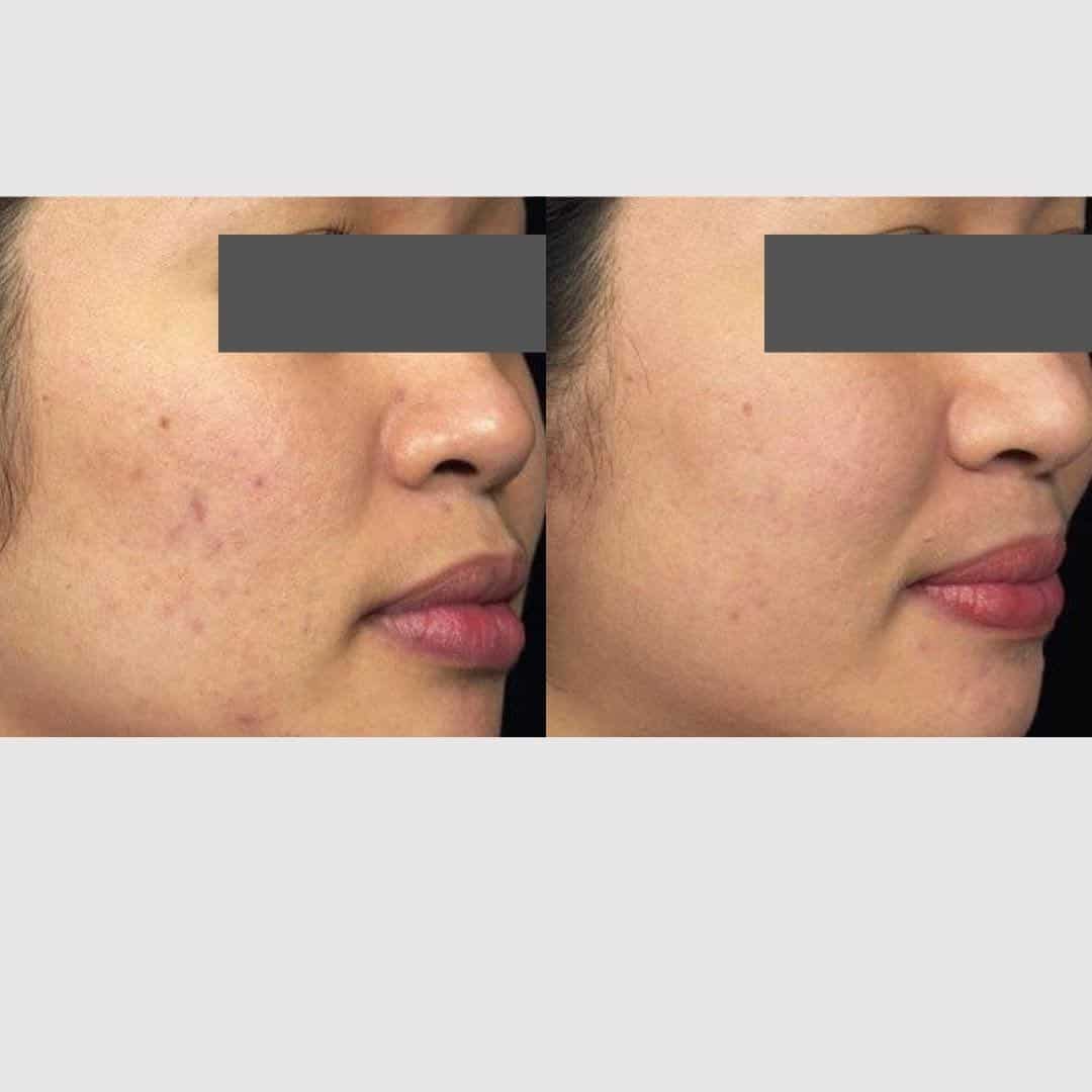 laser for acne-scarring
