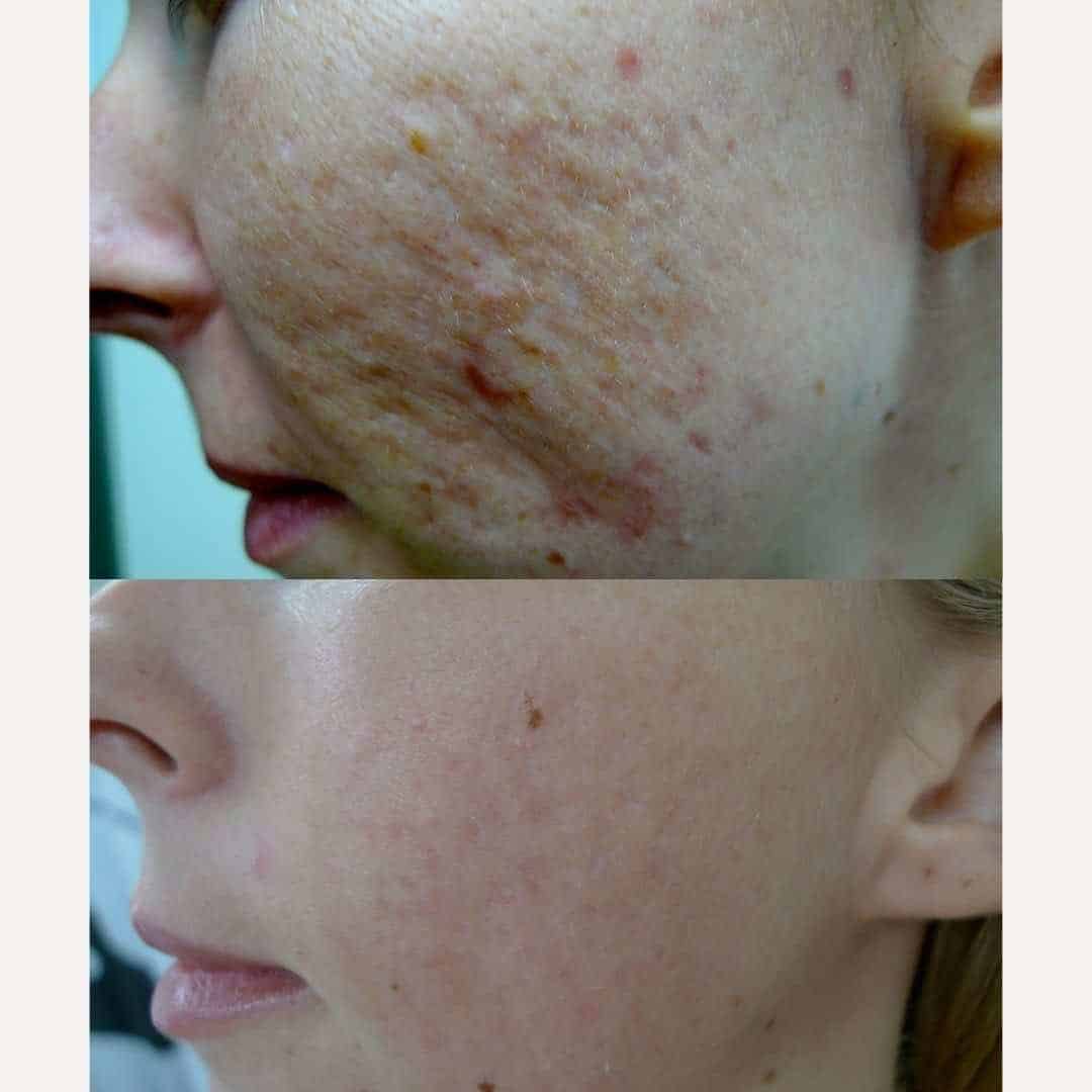 acne-and-acne-scars