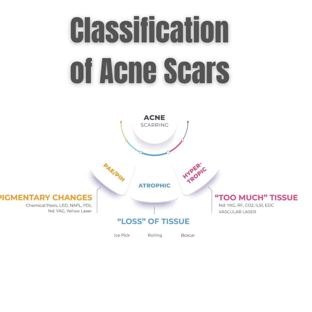 acne scar classificatoin