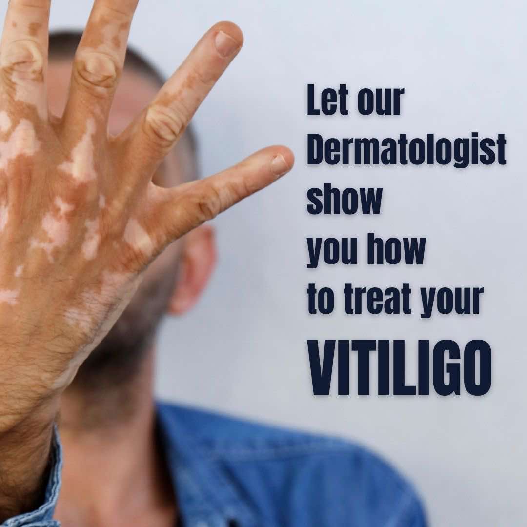 brisbane-clinic-vitiligo