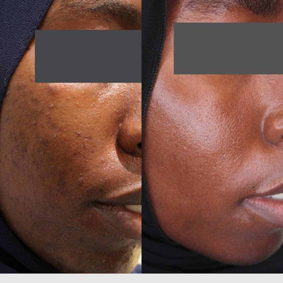 dark skin type with acne