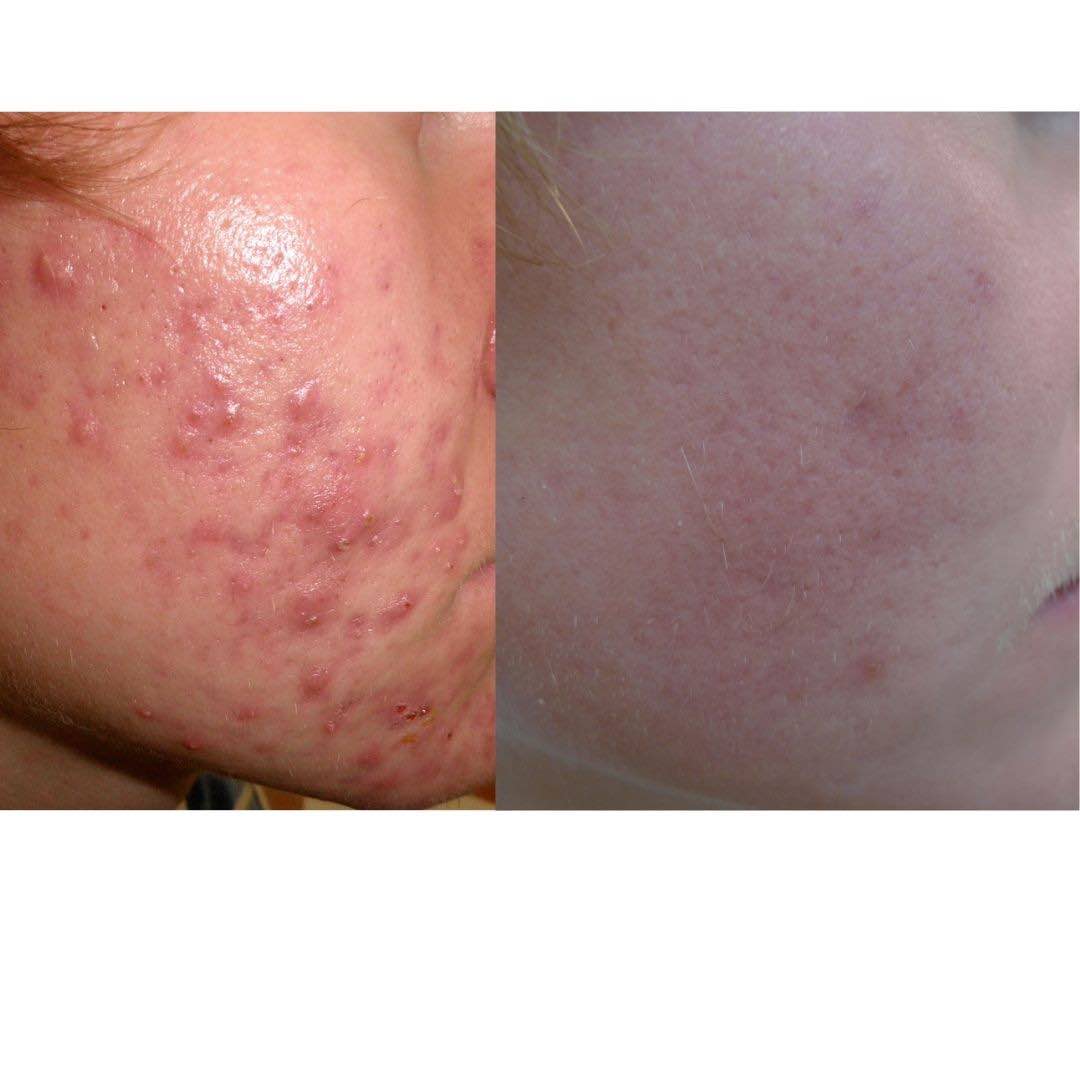 acne-before-after-dr-davin-lim