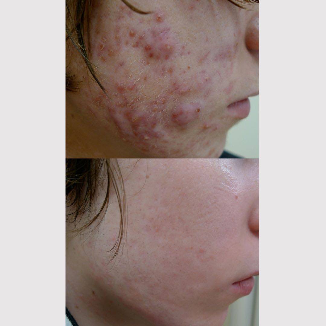 acne-scars