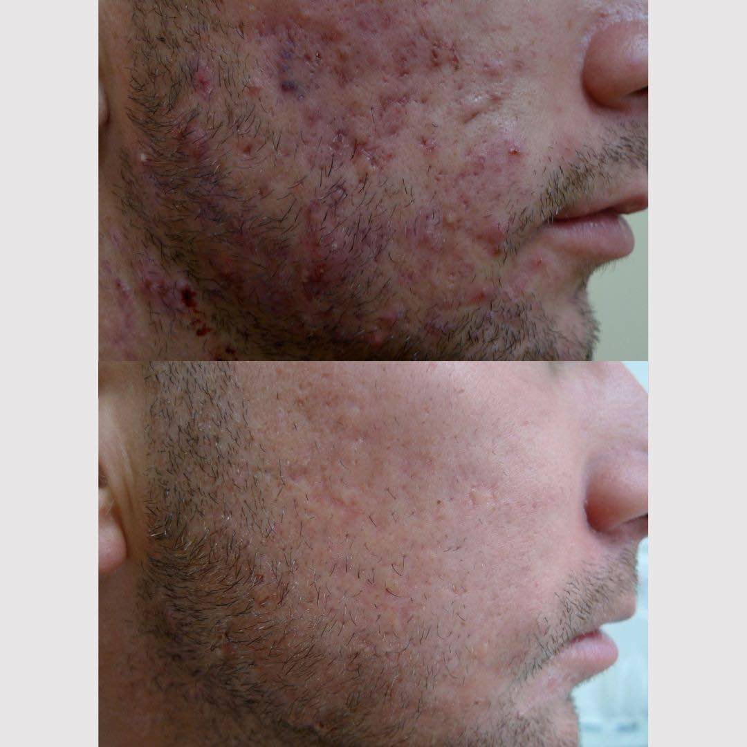 acne cysts