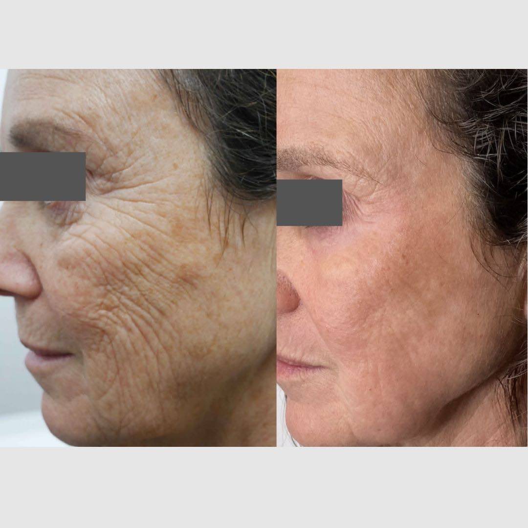 wrinkles-treated-with-lasers