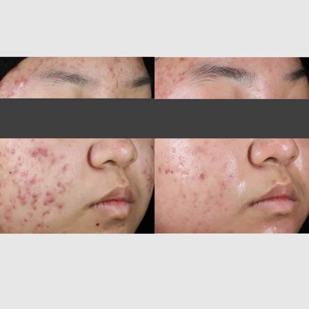 Retinol-acne-cure