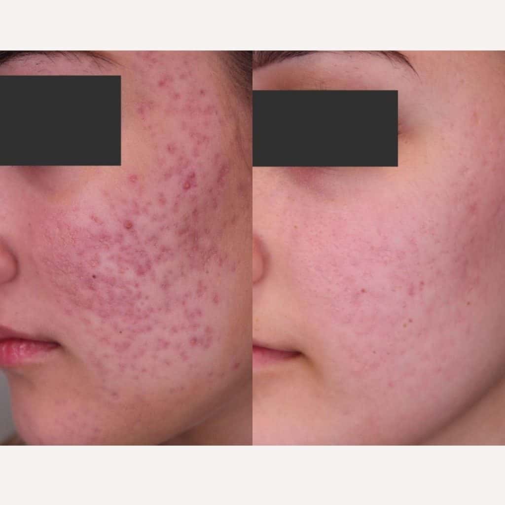 Professional Roaccutane Treatment In Australia Dr Davin Lim