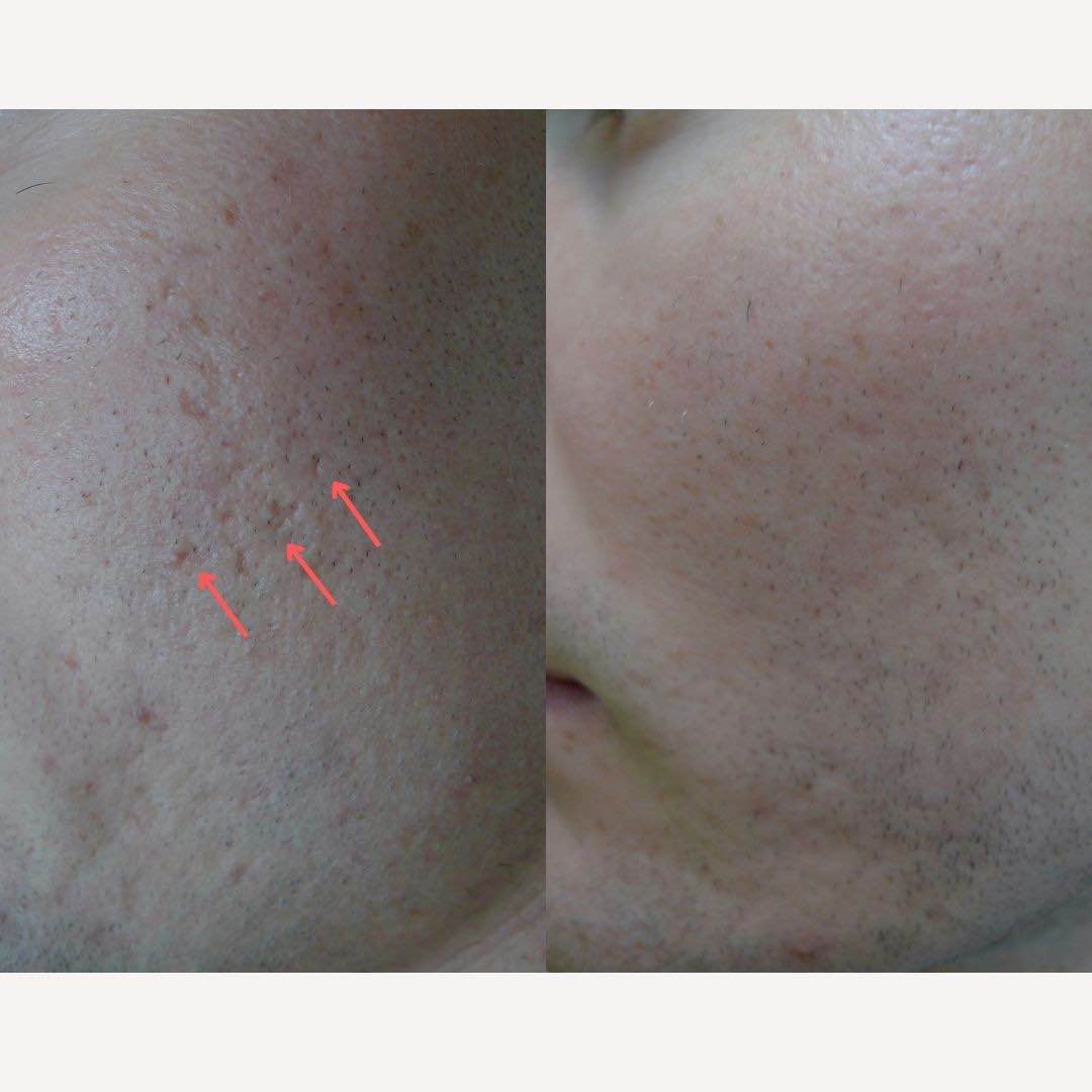 Boxcar acne scar removal