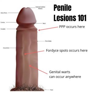 Guinness sponsor tempo Professional Pearly Penile Papules Treatment In Australia