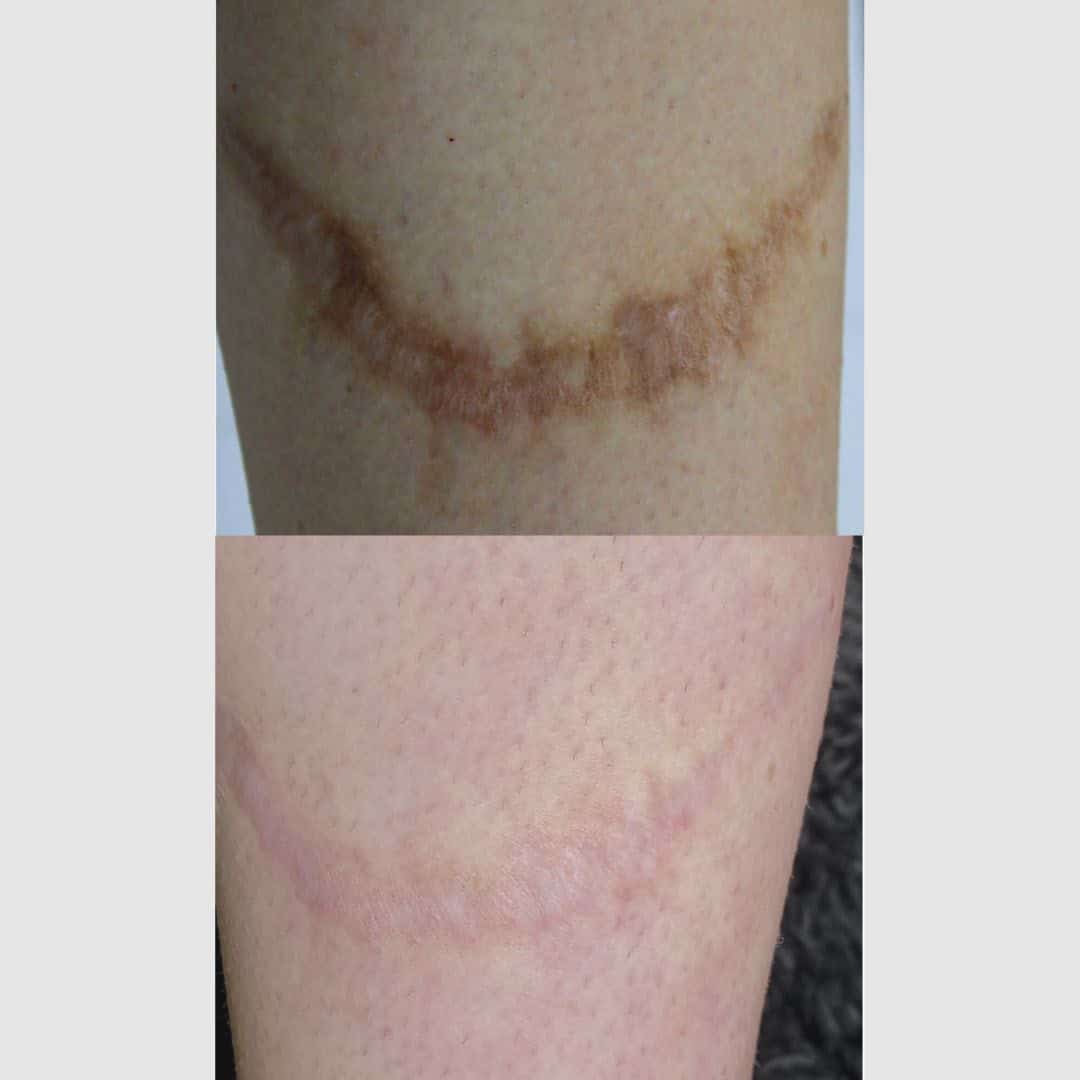EDS-scar-removal