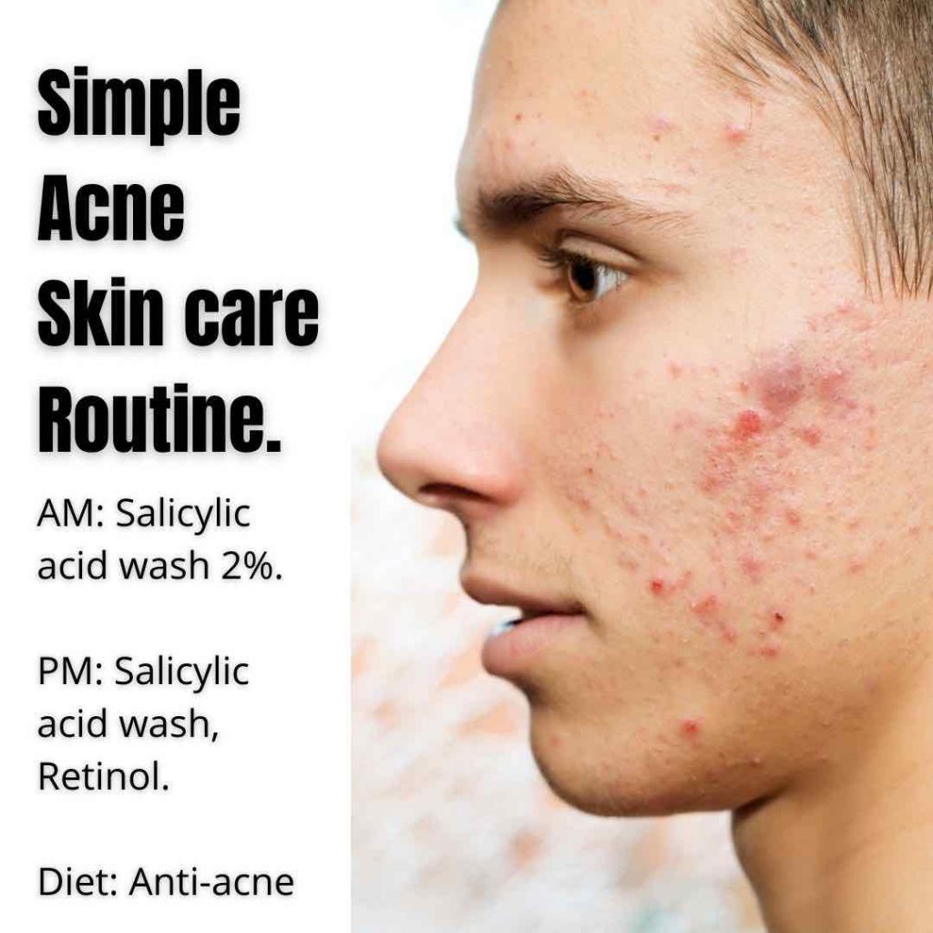 7 Ways To Treat Acne Without Medication Dr Davin Lim