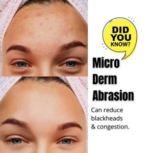 acne-microdermabrasion