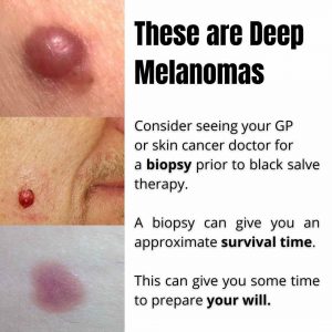 melanoma-amelanotic