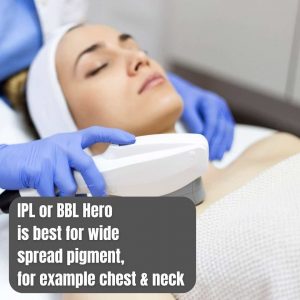 IPL-treatment-brisbane