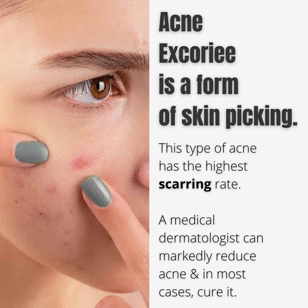 acne-picking