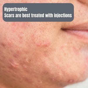 hypertrophic-acne-scars