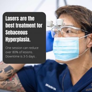 sebaceous-hyperplasia