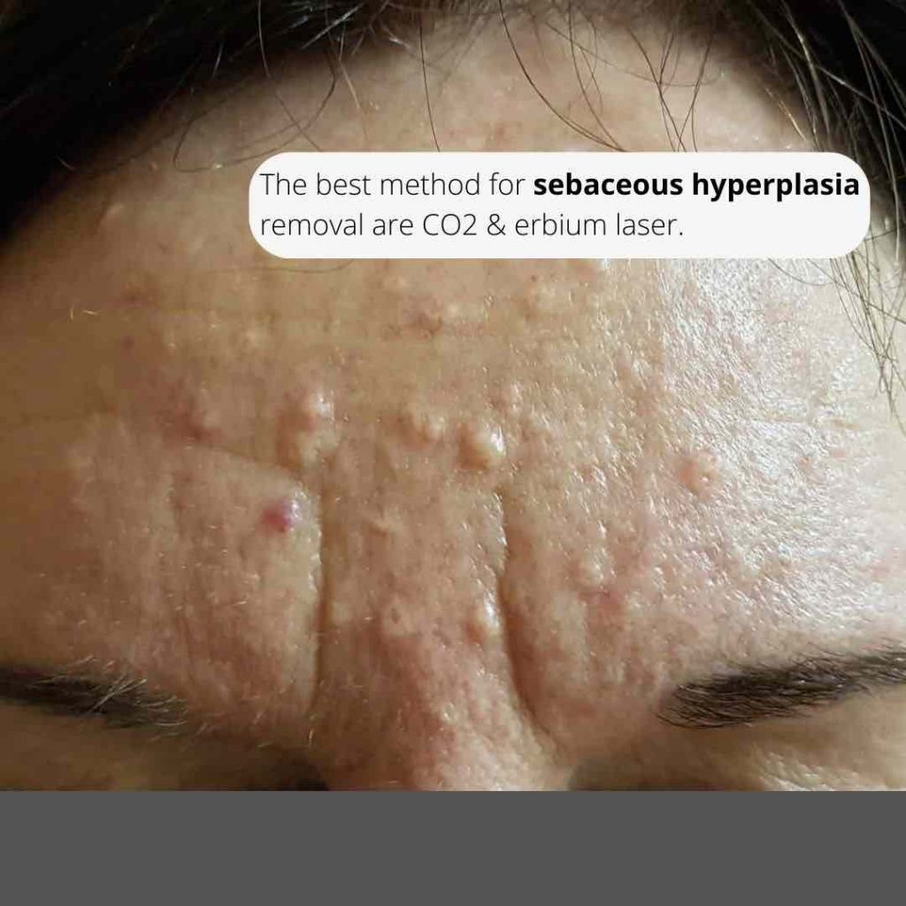 Best Sebaceous Hyperplasia Treatments In Australia 