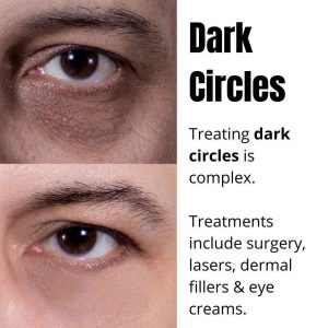 Dark Circles
