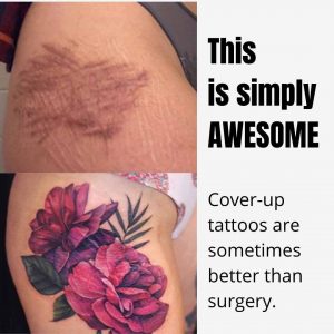 Tattoo Removal  Sierra Laser Clinic