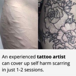 Cutting Scars - Tattoo Cover Ups - Dr Davin Lim