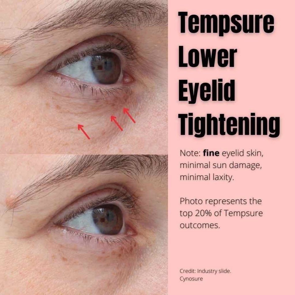 Best Eyelid Surgery In Brisbane 2024 Dr Davin Lim