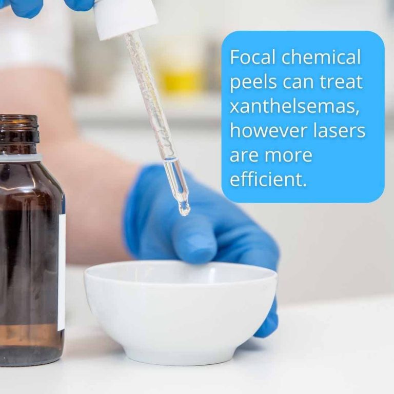 Best Xanthelasma Treatment In Australia 2024 Dr Davin Lim