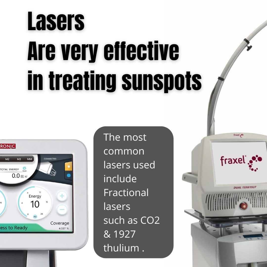 sun-spot-laser-treatment