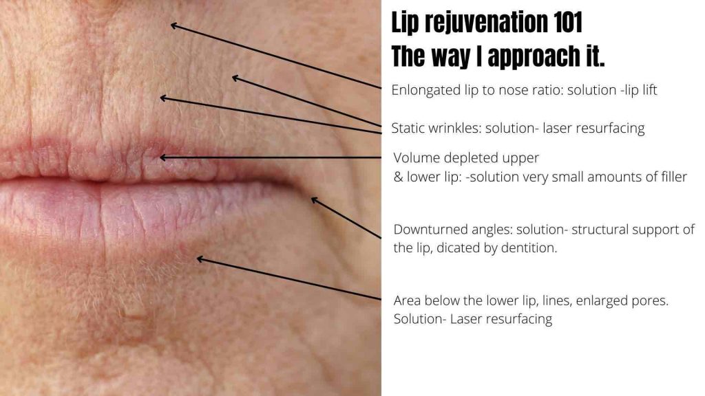 Best Upper Lip Lines Treatment In Australia | Dr Davin Lim