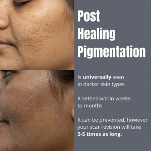 PIH acne scar