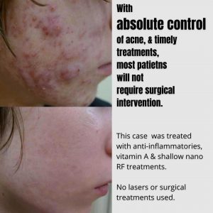 accutane cystic acne