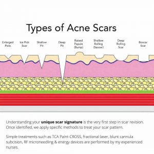 acne scar types 2