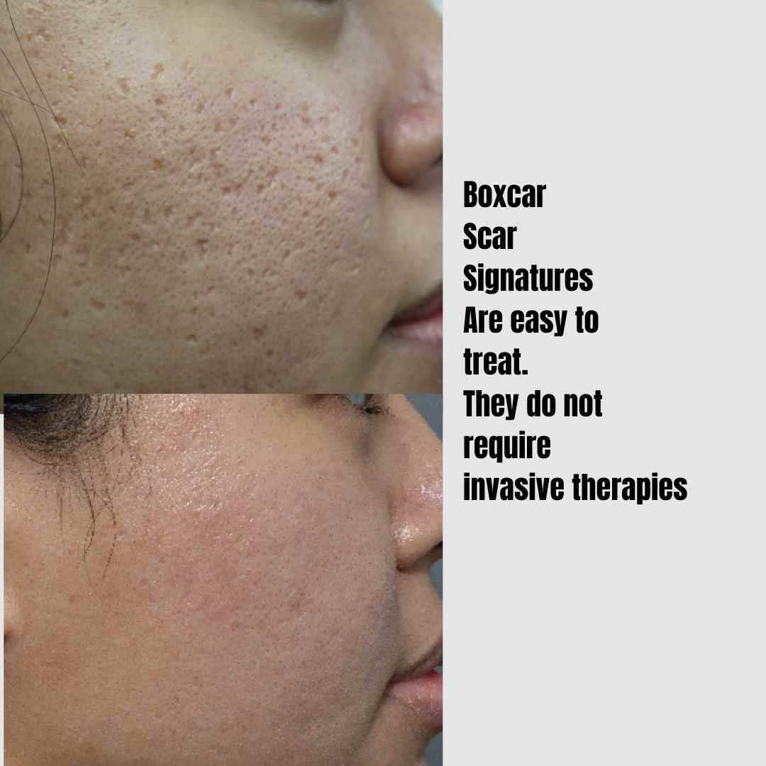 TCA Cross Acne Scars Treatment In Australia | Dr Davin Lim