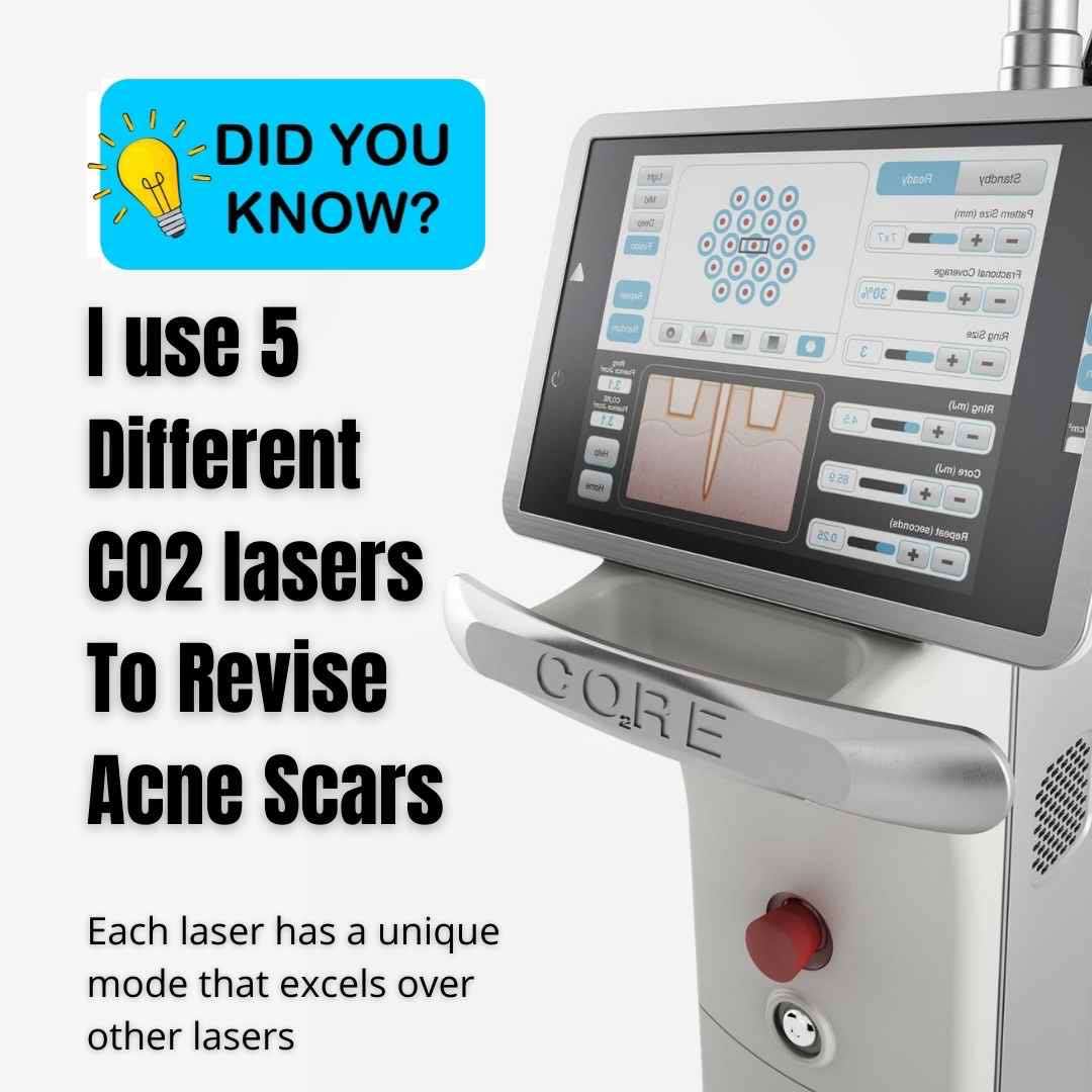 co2 laser acne scars